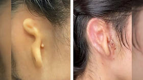 Woman receives 3D printed ear transplant