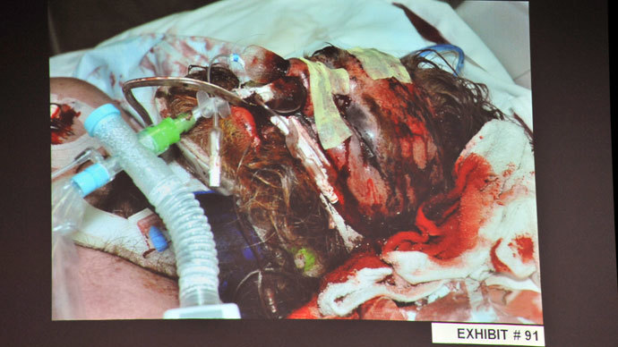 An evidence photo of beating victim Kelly Thomas in hospital, as it was shown during a preliminary hearing on his death, for Fullerton police officers Manuel Ramos and Jay Cicinelli at the Orange County Superior Court in Santa Ana, California May 7, 2012.(Reuters/Joshua Sudock)