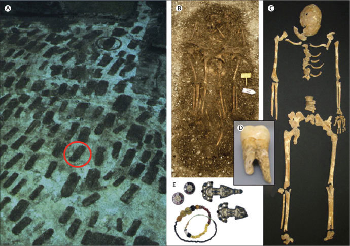 The cemetery in Bavaria, Germany (A). The skeleton of a victim of the Plague of Justinian (C). Objects (E) from the grave (B) that helped scientists to estimate the plague victimâs death as occurring between 525 AD and 550 AD. A tooth from which the genome of the plague was extracted (D). (Image from thelancet.com)