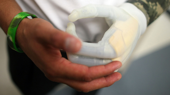 ​Nerve implants make bionic hand feel almost real