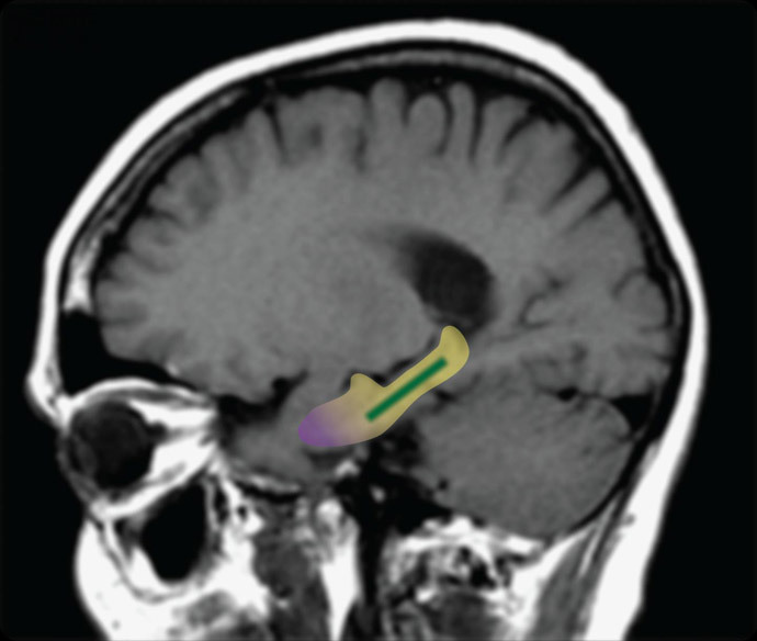 The brain area outlined in yellow is the hippocampus; the dentate gyrus is shown in green and the entorhinal cortex in purple. (Image from the press-release)