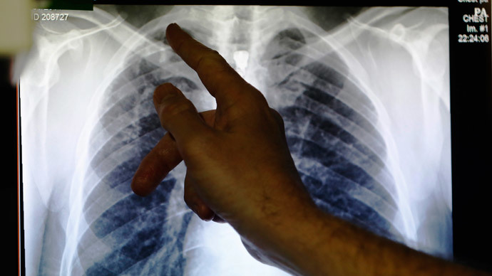 ​TB or not TB? Britain to eradicate disease ‘of the past’