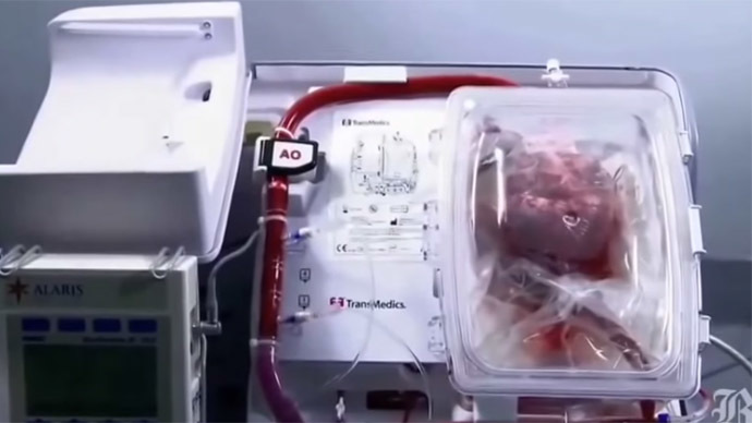 Europe’s first ‘dead' heart transplanted in UK
