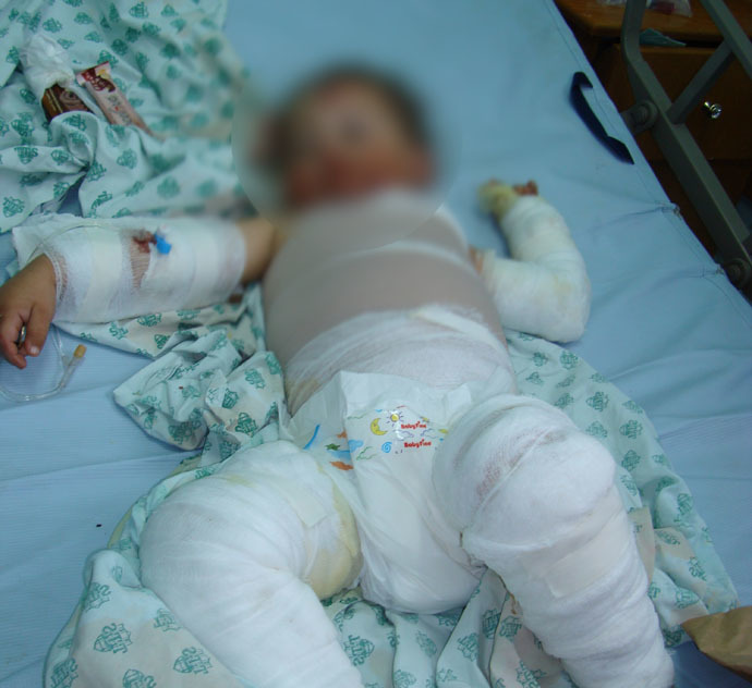 Farah Abu Halima, 3, severely burned by Israeli-fired White Phosphorus, January 4, 2009 (Photo by Eva Bartlett)