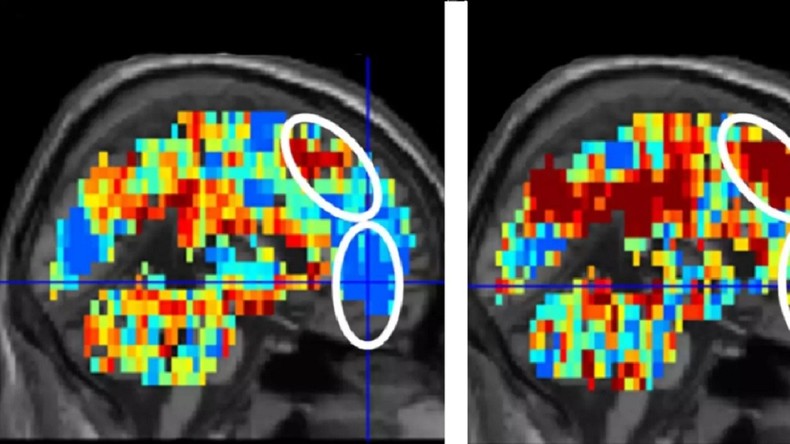 Un algorithme mis au point aux Etats-Unis pour détecter les gens aux tendances suicidaires