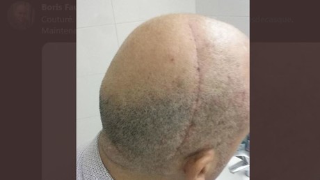 Cicatrice sur le crâne de Boris Faure, frappé à coups de casque en 2017 par le député ex-LREM M'jid El Guerrab.