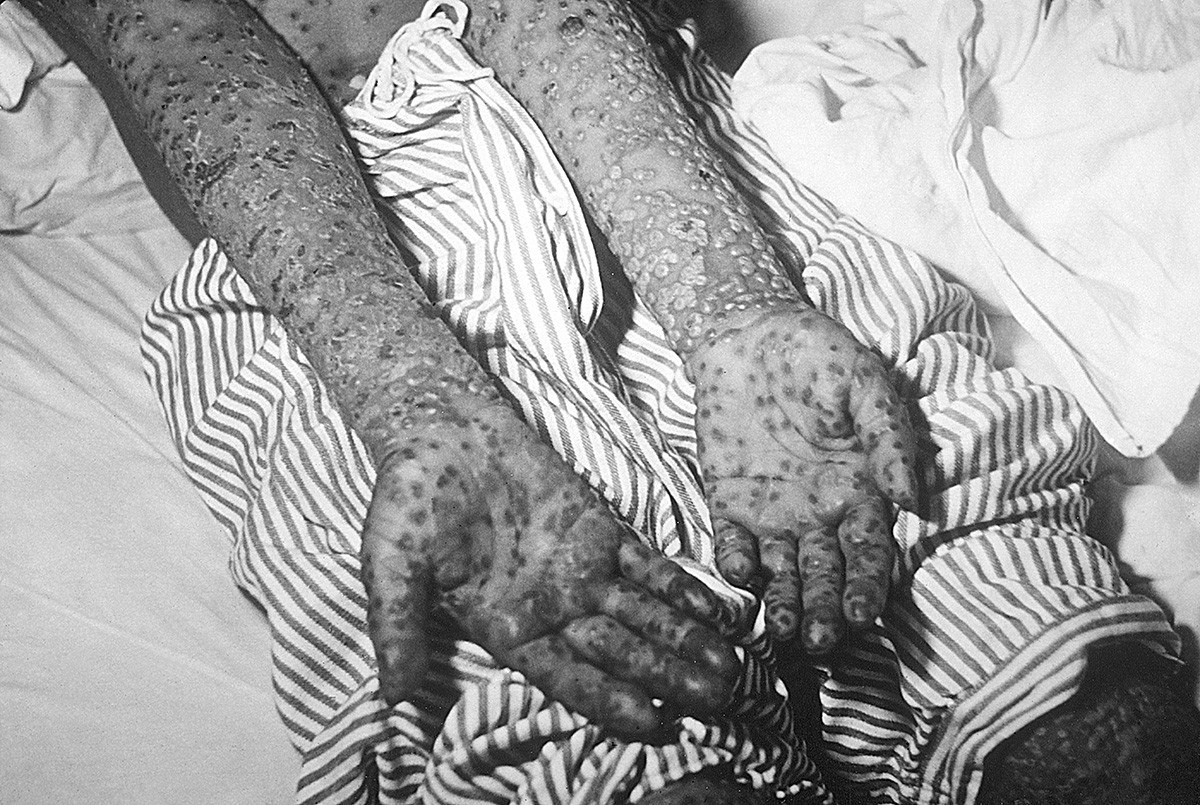 Osip na rukama bolesnika 1972.