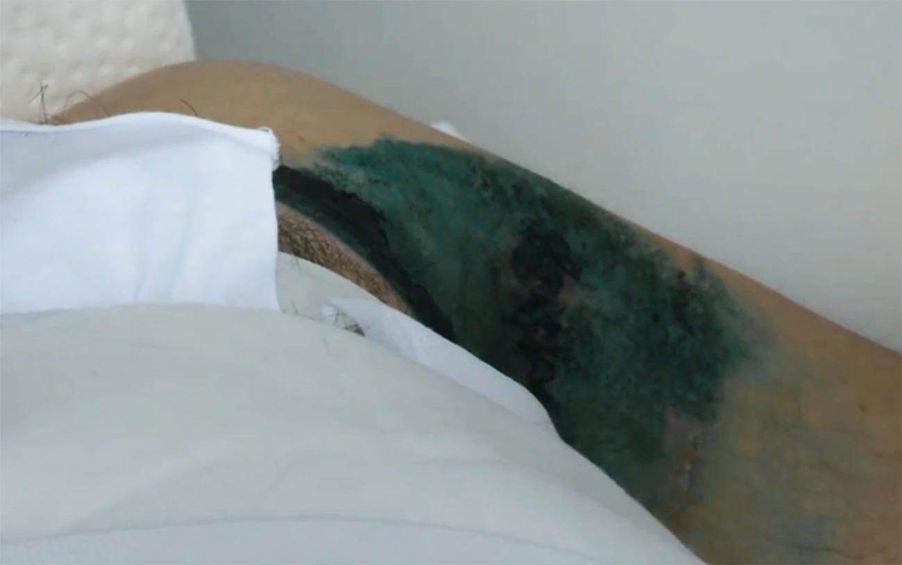 The burns on Salaud Akhmatov's armpit where the lightning entered his body