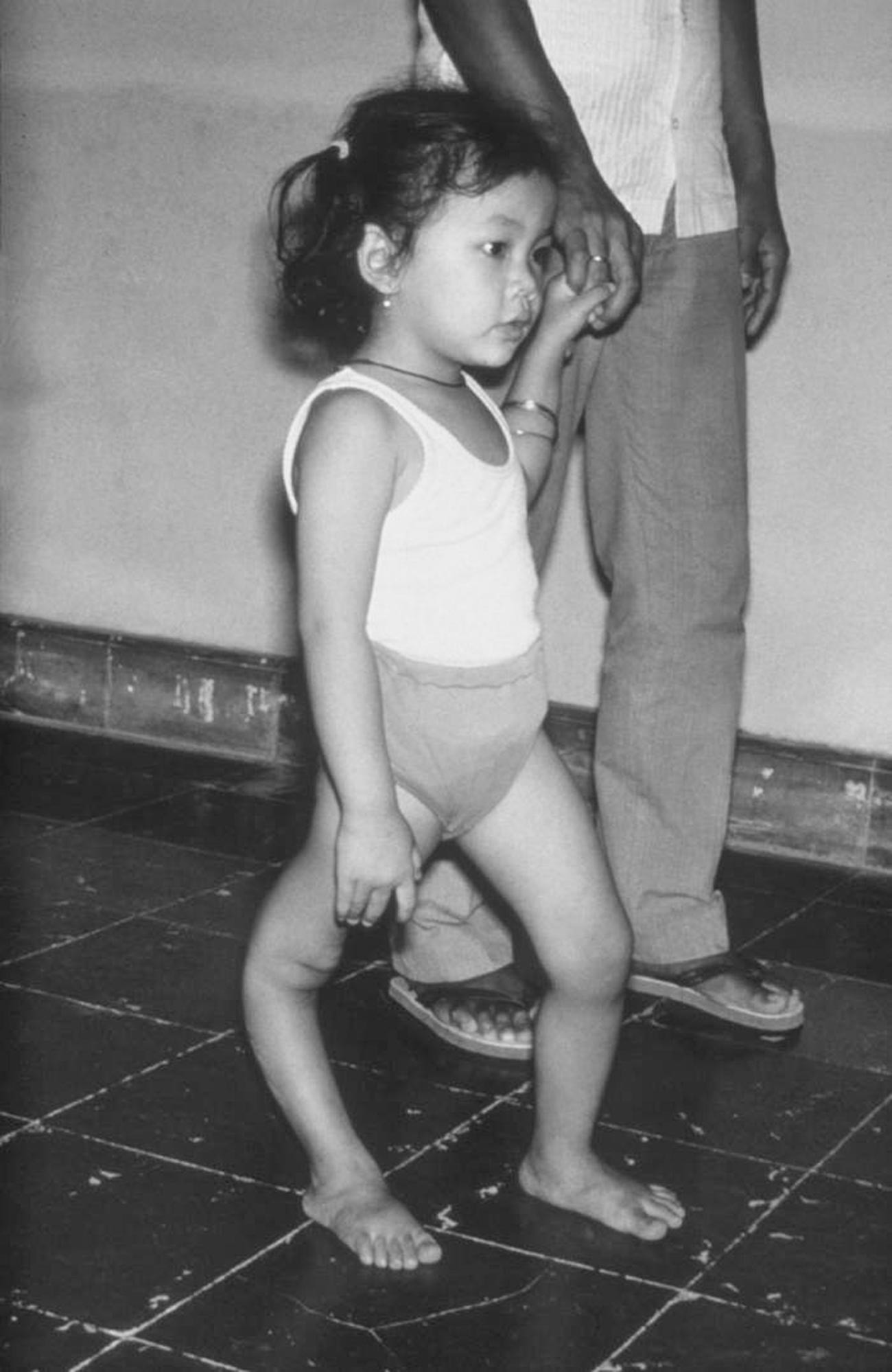 Menina com deformidade na perna direita devido à poliomielite