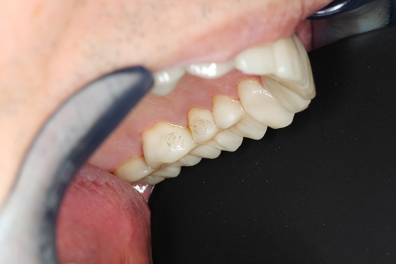 PutinTrump first phone call immortalized on teeth Russia Beyond