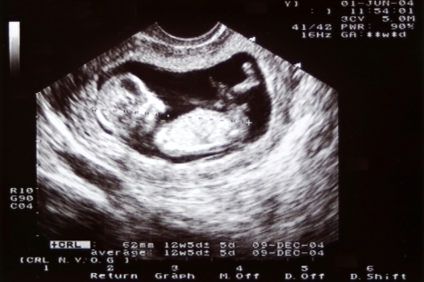 Na Rússia, o aborto é legal até a 12ª semana de gravidez Foto: PhotoXPress