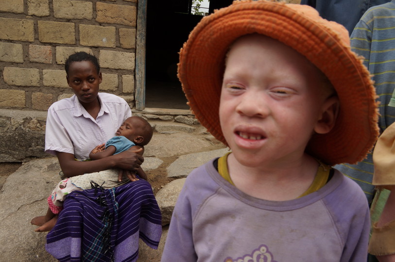 Albino children in Tanzania 