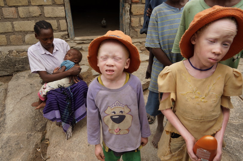 Albino children in Tanzania  